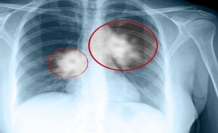 Sinsi seyreden akciğer kanserinin 8 belirtisi